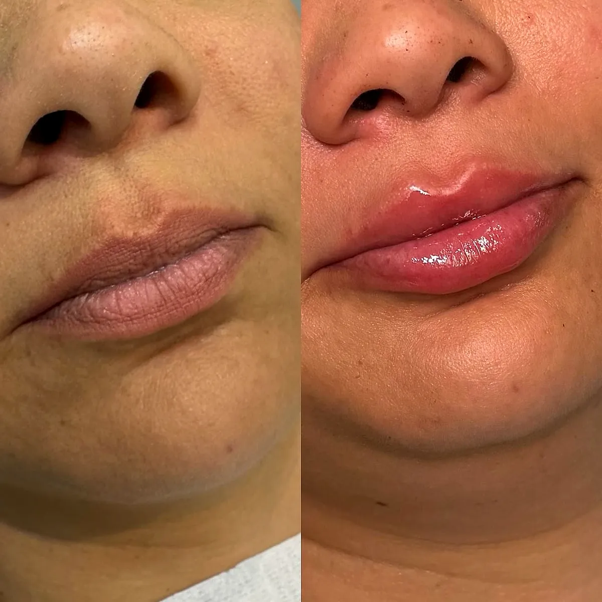Preenchimento labial: antes e depois