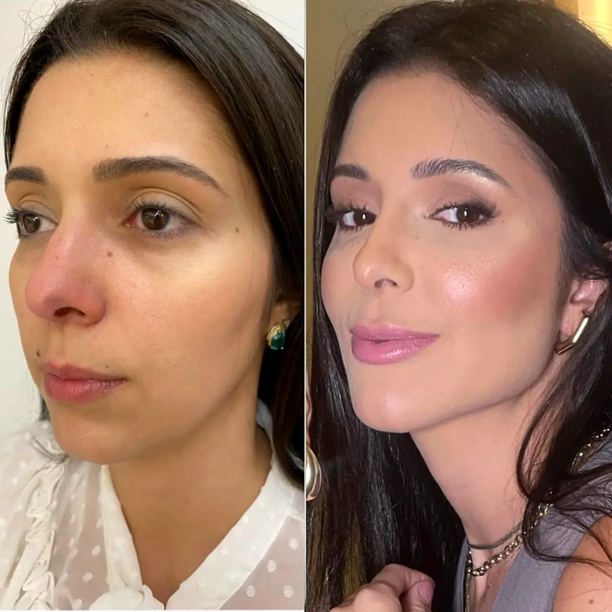 Harmonização facial: antes e depois