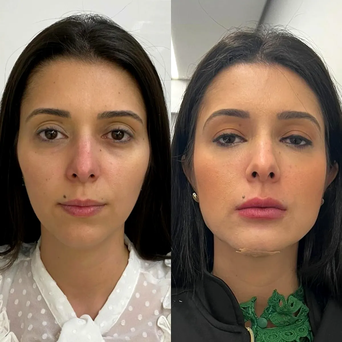 Harmonização facial: antes e depois