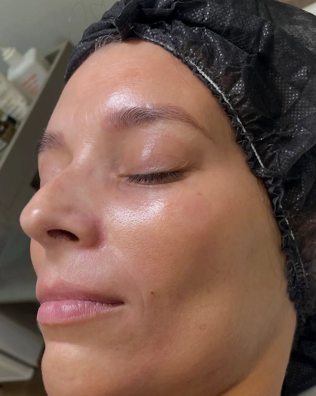 Pele depois do Lumina Peel